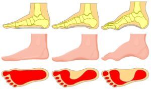 Best shoes for feet with no fat pad top