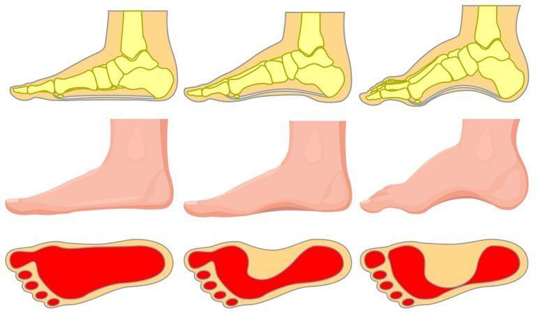 Best Shoes for Morton s Neuroma Best Running Shoes Walking Shoes