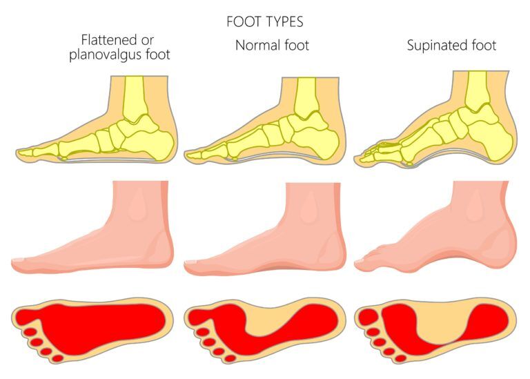 Best walking shoes for metatarsalgia 2025