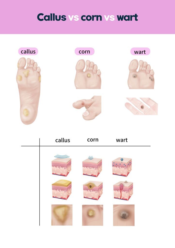 How to remove a corn from your foot Corn removal surgery near me