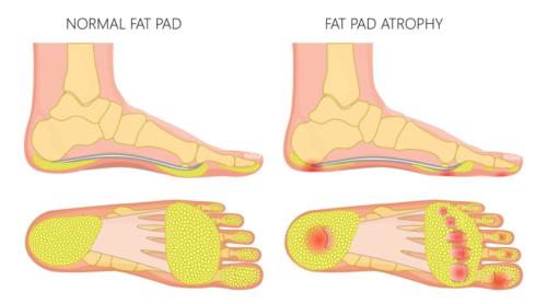 Bottom of heel swollen hotsell