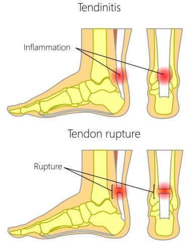 Swollen lump on achilles tendon on sale