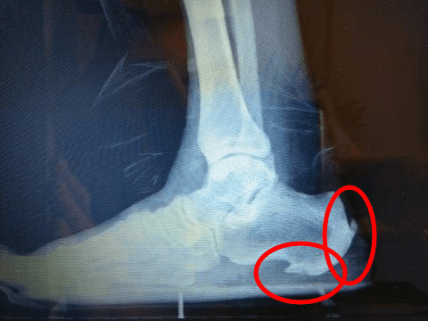 Achilles tendon bone spur surgery video 2025