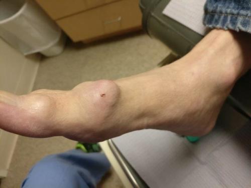 Bone spur on side of foot top