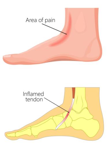 Best sandals for extensor tendonitis discount