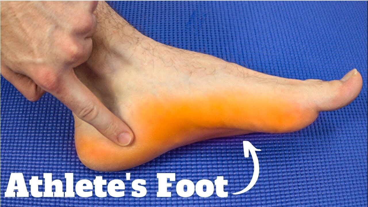 What is Athlete's Foot? Symptoms, Causes, & Treatments