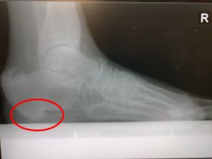 What is the Recovery Time for Heel Spur Surgery?