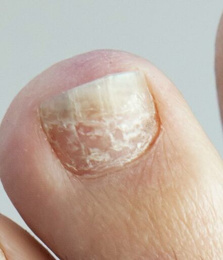 Canberra Ingrown Toenail Clinic | What Your Nails Say About Your Health