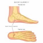 Baxter's Nerve Entrapment Heel Pain [ Pinched Heel Nerve Treatment]