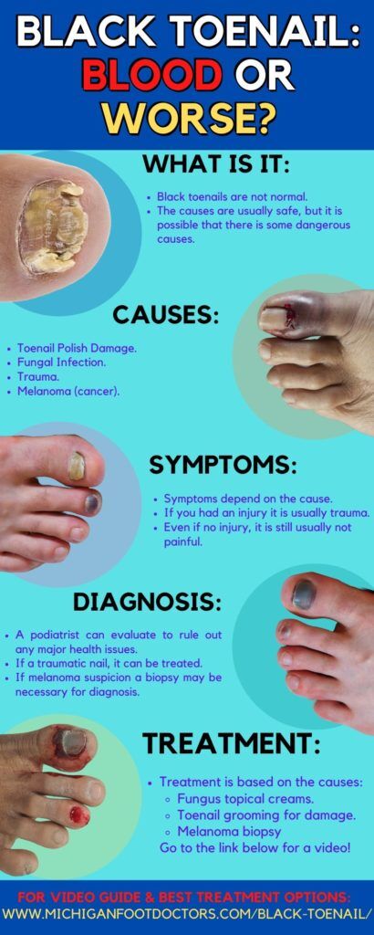 Curled Toe Nails? All About Pincer Nails and Ingrown Toenails