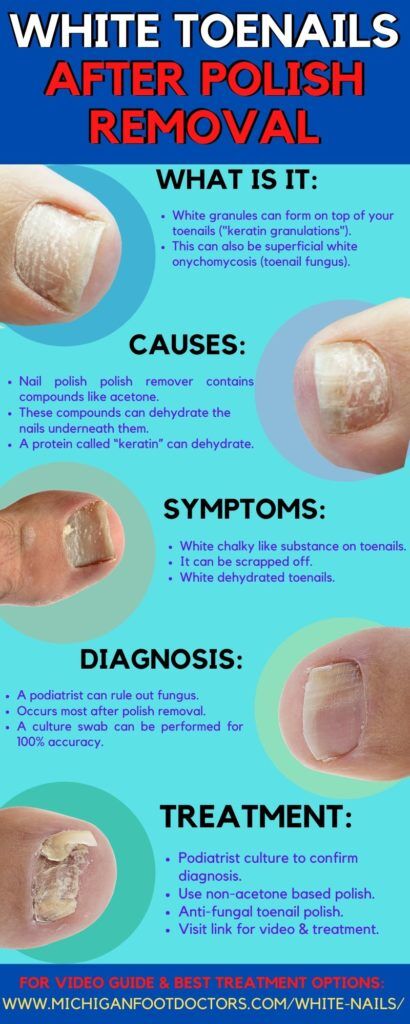 Tips for Dealing With Nail Psoriasis
