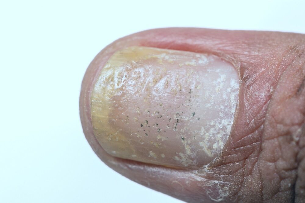 Nail Abnormalities: Common Types, Causes & Prevention