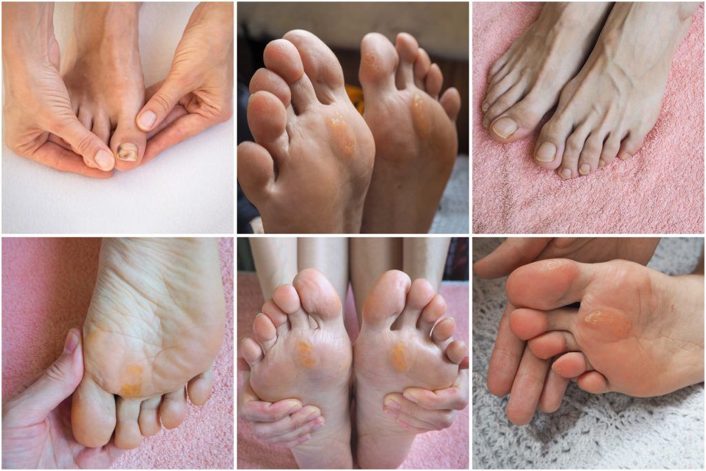 How To Treat Dry Feet | Advice For Dry Feet | NIVEA