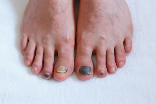 47d35d5ccf0b6dd86f85b9d0e9655979.human male foots with bruised black on toe nails on white background