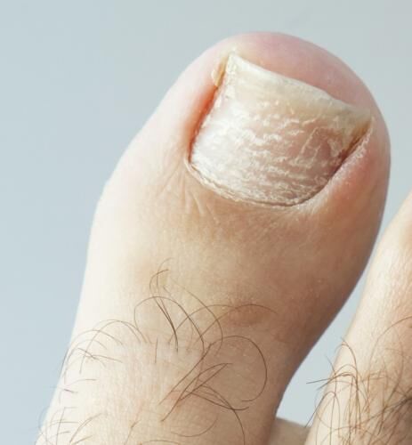Fungal Nail Laser Treatment & Podiatry Perth | The Nail Laser Clinic