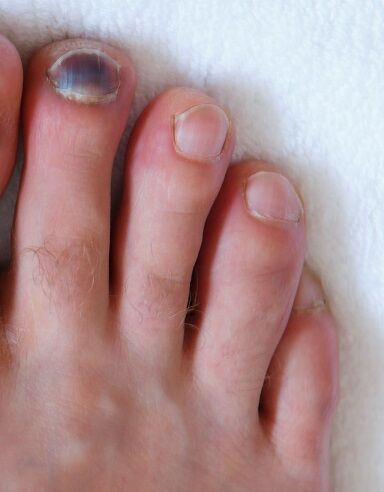 6b1427ec0fc65019c71eab695c29a1a9.human male foots with bruised black on toe nails on white background 1