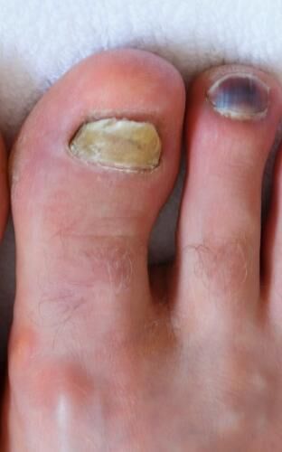 92b1be65aff46f8d682103e74c0f7b0e.human male foots with bruised black on toe nails on white background 2
