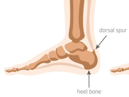 Plantar Fasciitis Surgery – The Complete Guide | Foot & Ankle