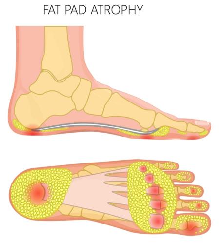 Causes of Heel Pain (