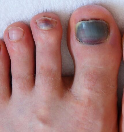 Discoloured toenails hi-res stock photography and images - Alamy